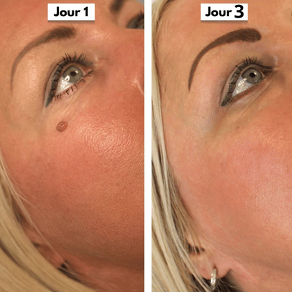 Skinova Labs™ - Dites Adieu aux acrochordons